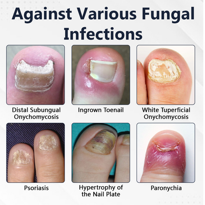 Ceoerty® NailFungiClear Pro Antifungal Pen