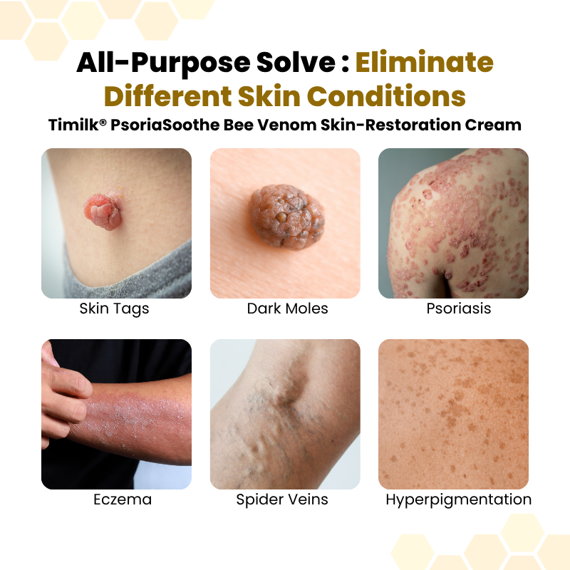 Timilk® PsoriaSoothe Bee Venom Skin-Restoration Cream⚕️