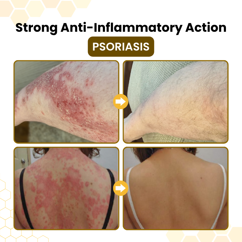 Timilk® PsoriaSoothe Bee Venom Skin-Restoration Cream⚕️