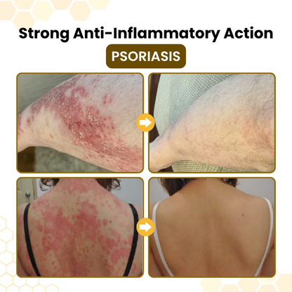 Timilk® PsoriaSoothe Bee Venom Skin-Restoration Cream⚕️