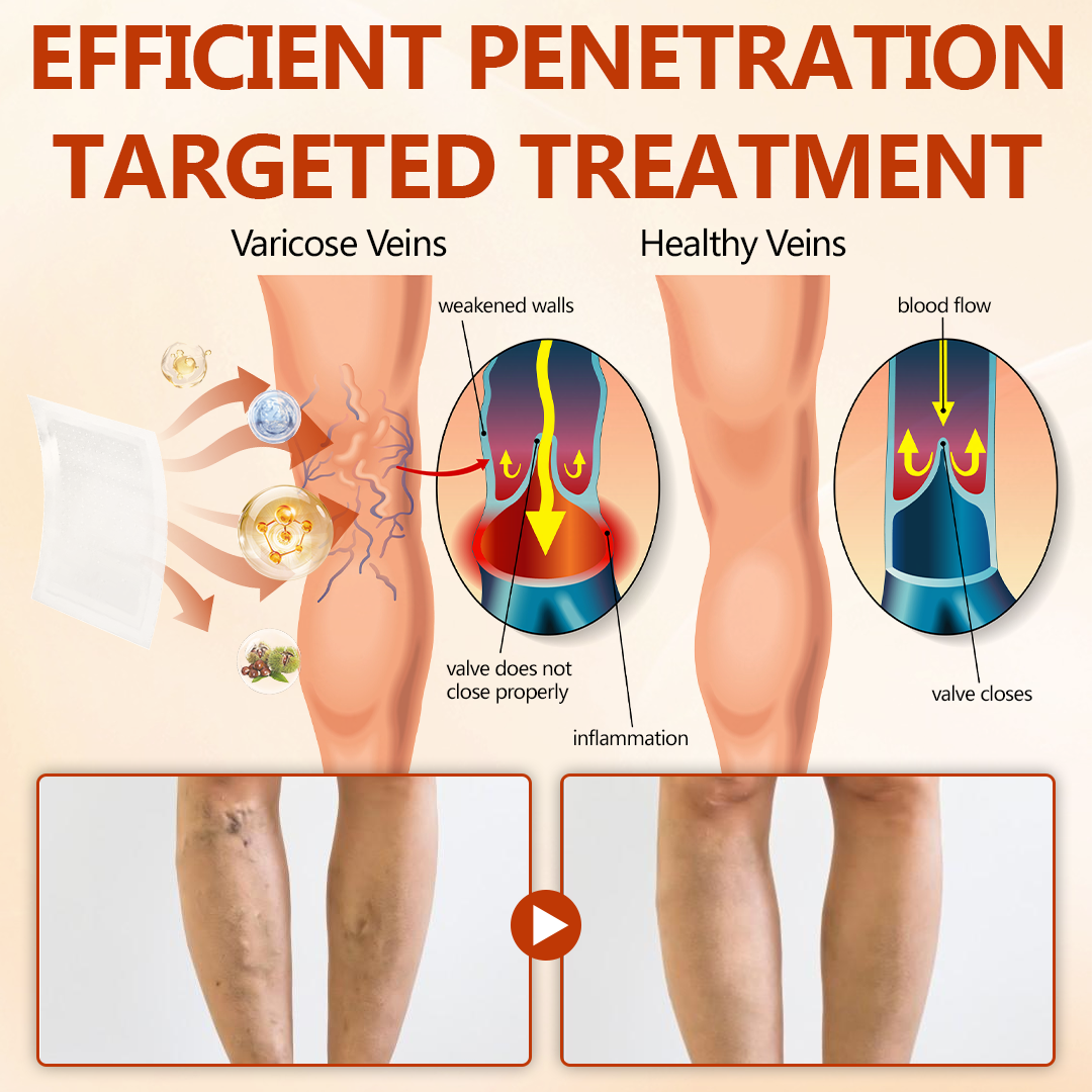 🔥 LIMITED SPECIAL OFFER🔥Timilk® VeinRepair Microneedle Patch Roll🦵✨ (Advanced Microneedle Vein Repair Patch for Bulging Veins, Swelling, Heavy Legs & Daily Leg Discomfort)