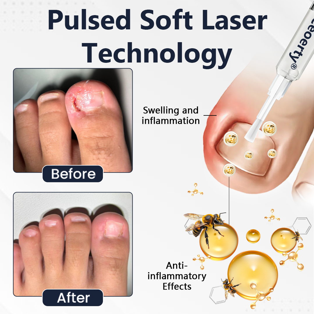 Ceoerty® NailFungiClear Pro Antifungal Pen